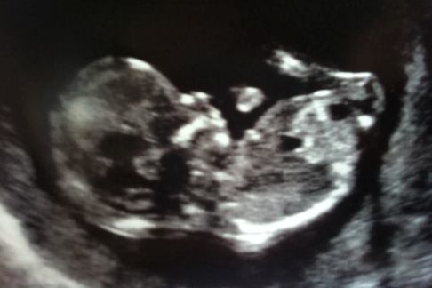 Ultrasound of an unborn baby at 13 weeks
